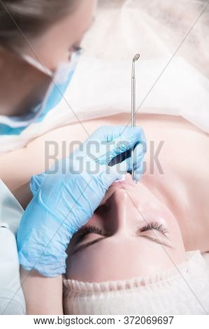 Close-up Mechanical Face Peel At The Beautician. Beautician Squeezes Acne On The Patients Forehead W