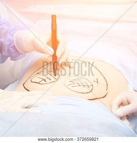 Surgery Room. Belly Surgery. Doctor Mark Liposuction Area At Tummy. Drawing At Skin. Anti Cellulite 