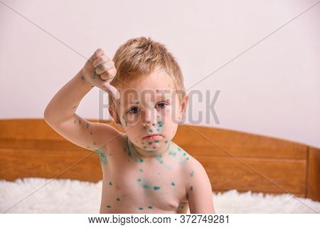 Young Toddler,boy With Chickenpox. Sick Child With Chickenpox. Varicella Virus Or Chickenpox Bubble