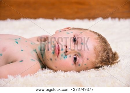 Young Toddler,boy With Chickenpox. Sick Child With Chickenpox. Varicella Virus Or Chickenpox Bubble