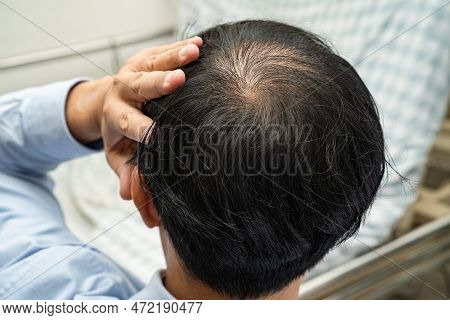 Bald In The Middle Head And Begin No Loss Hair Glabrous Of Mature Asian Business Smart Active Office