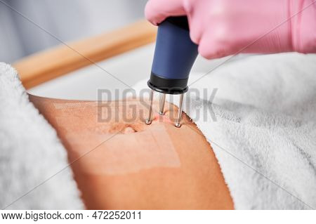 Close-up View Of Skin Abdomen Immediately After Treatment With Carbon Dioxide Laser. Laser Device Gr