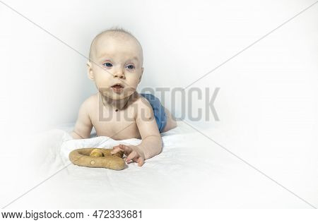 A Baby With A Hemangioma On His Neck Lies On A White Background. A Five-month-old Girl In A Reusable