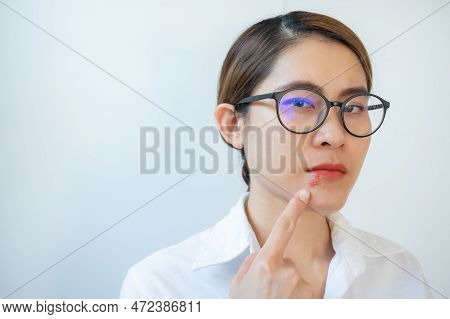 Asian Woman Pointing To Herpes Labialis Occur On Her Lower Lip. Blisters That Break Open And Form Sm
