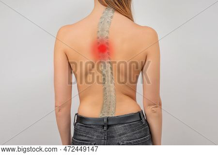 Woman With Scoliosis Of The Spine. Curved Woman's Back. Severe Pain In Upper Thoracic Spine