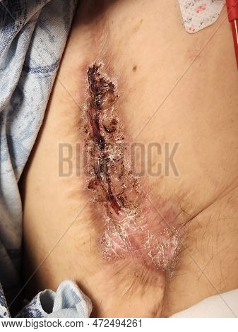 Factitious Disorder - Self-induced Severe Abdominal Skin Excoriations