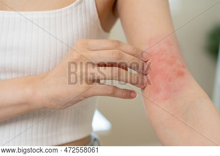 Dermatology, Asian Young Woman, Girl Hand In Her Arm Allergy, Allergic Reaction From Atopic, Insect 