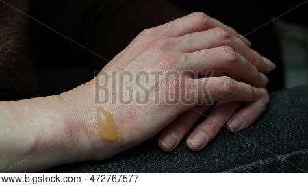 Close-up Of A Woman's Hand With A Blister From A Boiled Water Burn, Damaged Skin, 1st Or Second Degr