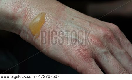Close-up Of A Woman's Hand With A Blister From A Boiled Water Burn, Damaged Skin, 1st Or Second Degr