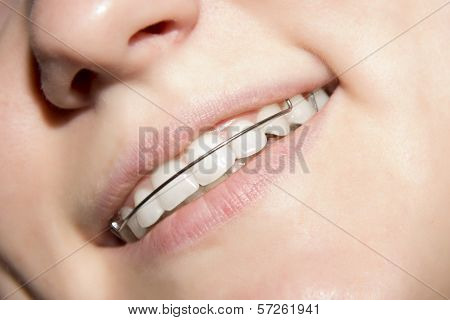 The Young Girl Smiling With Braces On Teeth