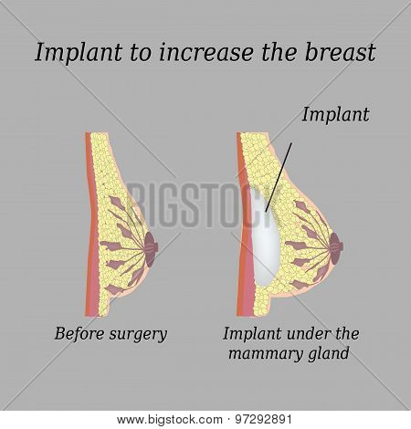 The implant in the breast on a gray background
