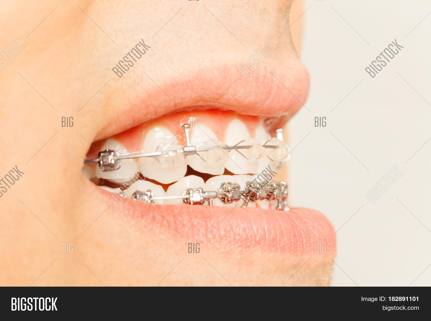 Close Braces On Teeth Image & Photo (Free Trial) Bigstock