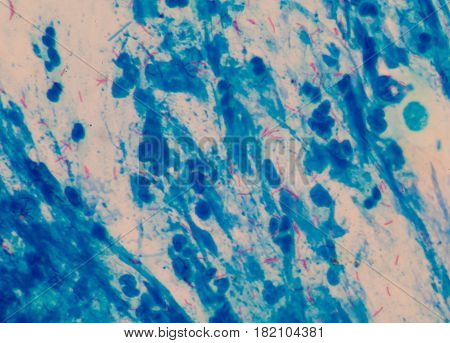 Red Cells Microbacterium Tuberculosis On Blue Background Medical Science.