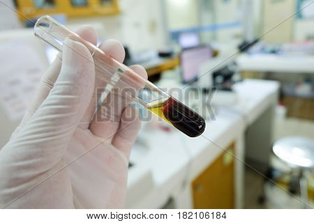 Clotted Blood  With Serum In Tes Tube  Laboratory Background.