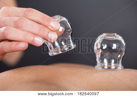 Close-up Of A Therapist Giving Cupping Treatment On Back
