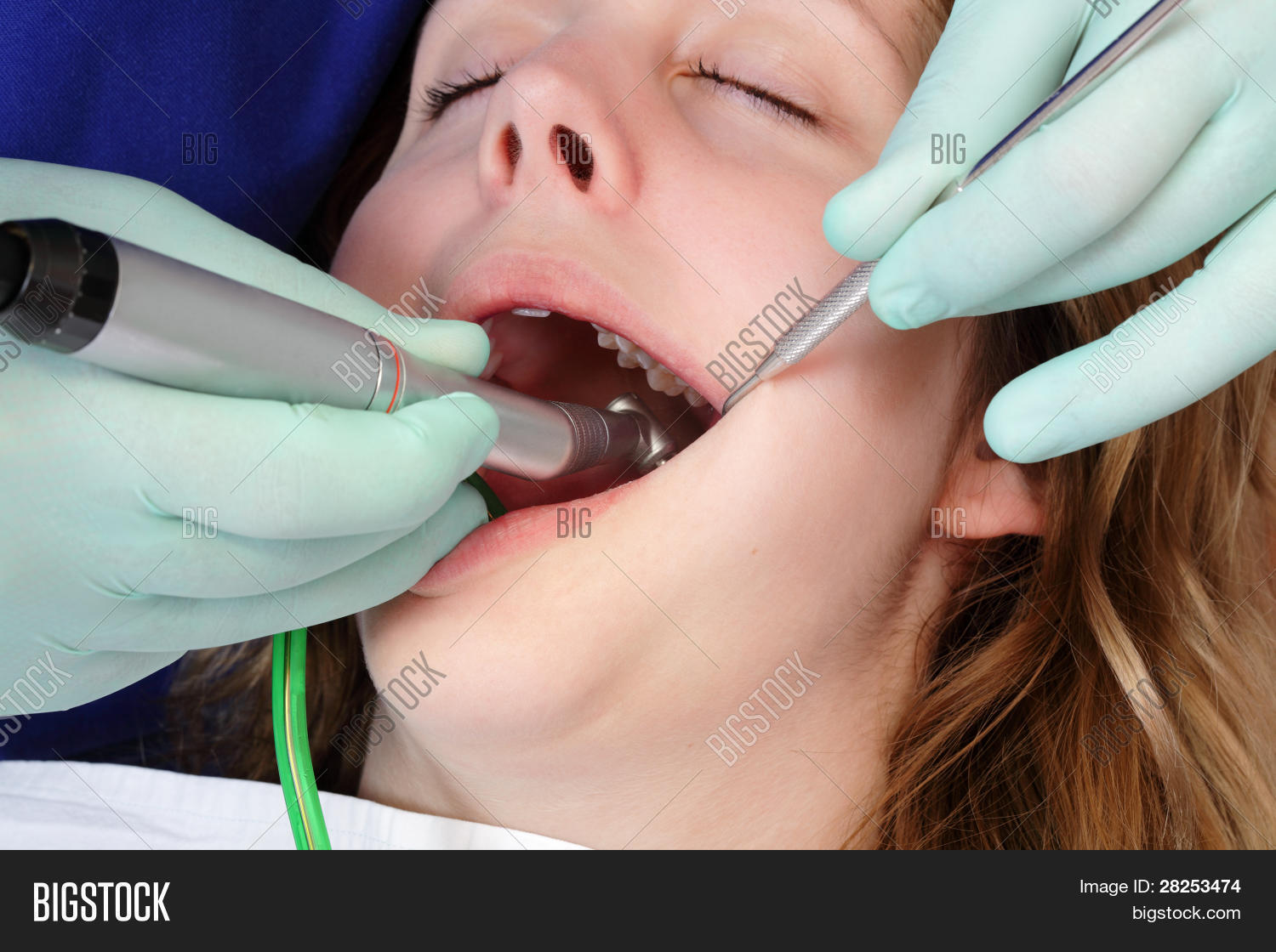 зуб после сверления. зуб после сверления. классификация кариес пульпит периодонтит. зуб после сверления. начальная степень кариеса.