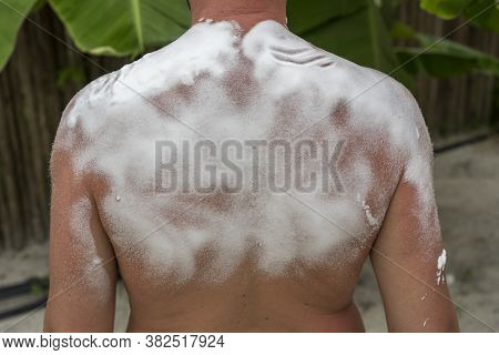 Sunburned Man With Cooling Foam On Her Back. Man Got Sunburn And Tan On Her Shoulder. Skin Care Conc
