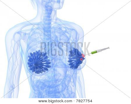 iniezione di cancro al seno