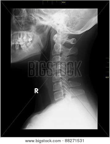 Lordosis