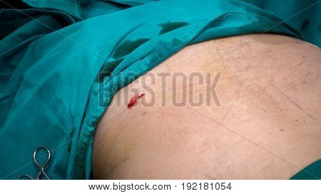 lesion after doctor use a surgery blade open surgery areafat removal