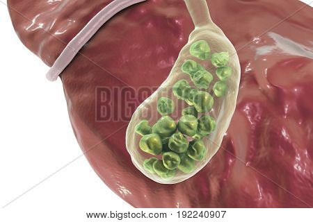 Gallstones, 3D illustration showing bottom view of liver and gallbladder with stones