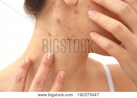 Allergy concept. Young woman with pimples on her face, closeup