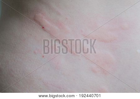 Close up of urticaria on women skin.
