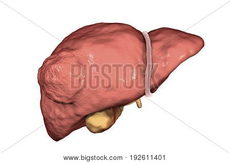 Liver cancer. 3D illustration showing presence of tumor inside liver