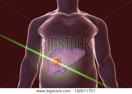 Liver cancer treatment with laser. Conceptual image. 3D illustration
