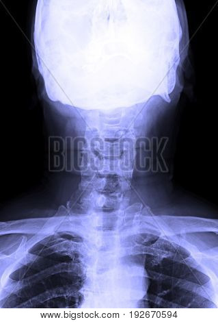 X-ray Image Of Male Human Neck