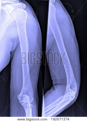 X-ray Image Of Male Shoulder And Joints