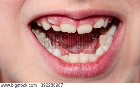 Children's Teeth. The Molar Grows In The Second Row. Anomalies Of Tooth Growth.