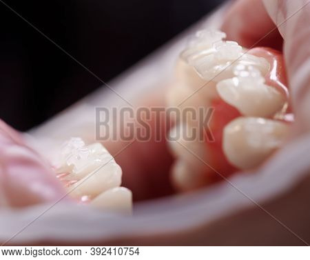 Close Up Of Person With Opened Mouth And White Teeth With Orthodontic Braces. Patient With Cheek Ret