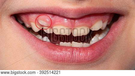 Children's Teeth. The Molar Grows In The Second Row. Anomalies Of Tooth Growth.