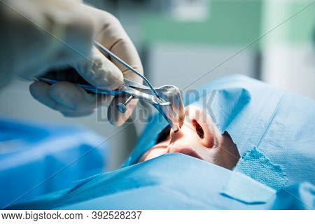Functional Rhinosurgery To Restore Nasal Breathing With Coblation Technology.