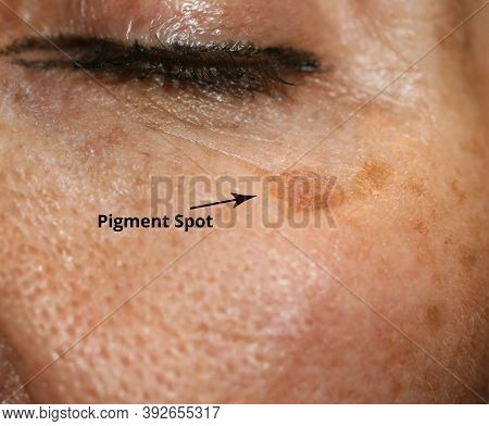 Brown Spot On The Skin Of The Face. Pigmentation On The Skin