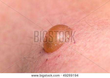 Blister Wound on the Skin, close up