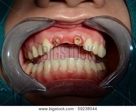 After Removing Ceramic Bridge