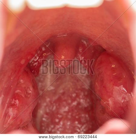 Open mouth view of tonsils