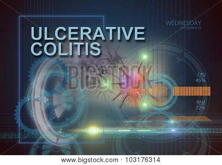 Ulcerative Colitis