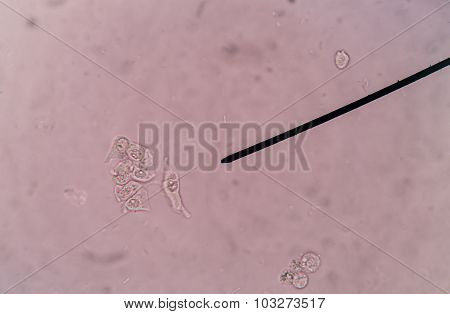 Renal Epithelial Cells In Urine.