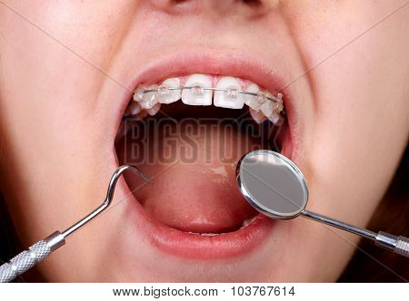 Teeth with orthodontic brackets. Dental health care.