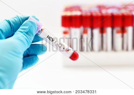 Blood sample with hepatitis C virus (HCV) positive