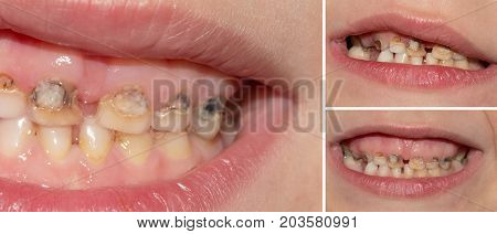 Dental medicine and healthcare - human patient open mouth showing caries teeth decay