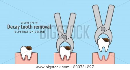 Decay Tooth Removal Illustration Vector On Blue Background. Dental Concept.