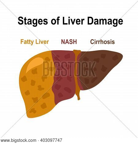 Stage Of Liver Damage- Fatty Liver, Nash And Cirrhosis In Flat Design On White Background. Design Fo