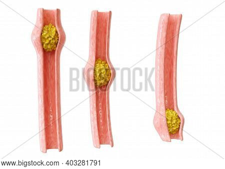 Peristalsis Is The Contraction Of The Muscles Of The Organs Of The Digestive Tract Allowing The Move