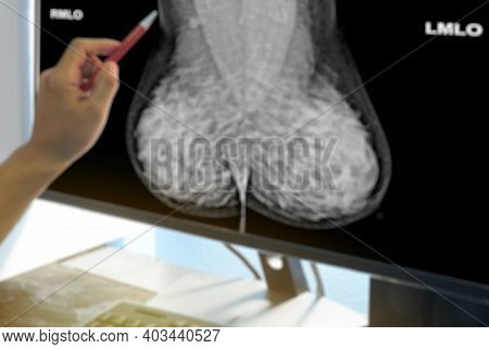 Blurred Close Up Hand Oncology Doctor Point  Examining A Mammogram Result On Medical Monitor On Brig