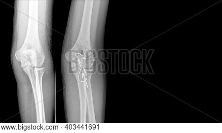 X-ray Elbow Showing Fracture (proximal Ulna Or Olecranon Fracture) Treated By Surgery With Tension B