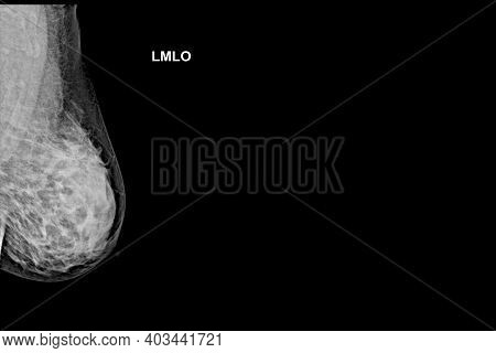 Special Mammogram Image (cmediolateral Oblique - Mlo)examination In Women Over The Age Of 40 -left B